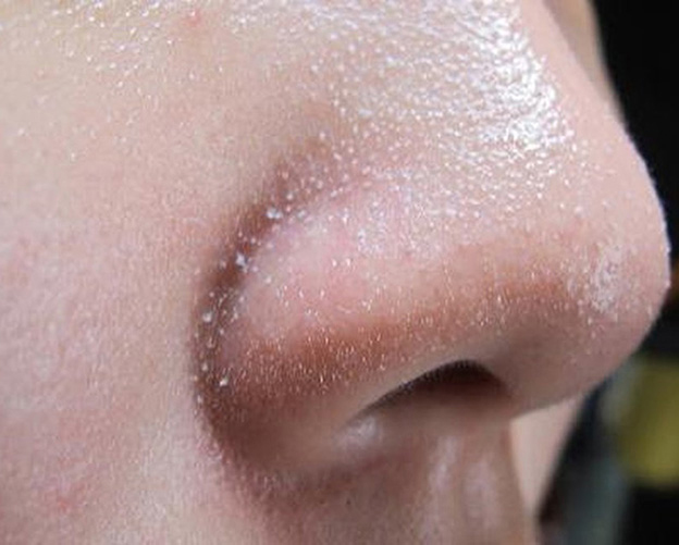  Trị Mụn Ẩn Và Mụn Cám Tại Sen Beauty